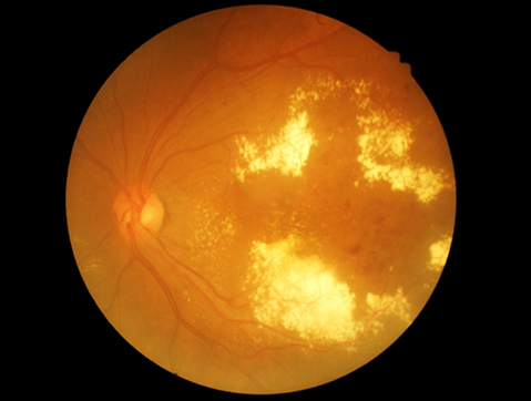 Diabetic Retinopathy scan