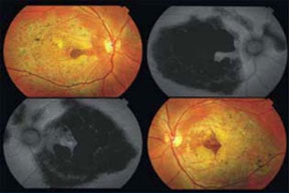 Heidelberg Retina Tomography image