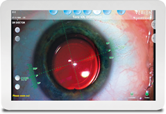 Verion Eye Imaging